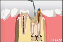 traitement radiculaire