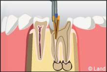 traitement radiculaire