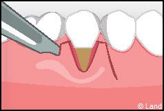 Chirurgie mucogingivale