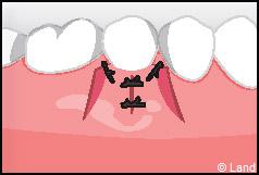 Chirurgie mucogingivale
